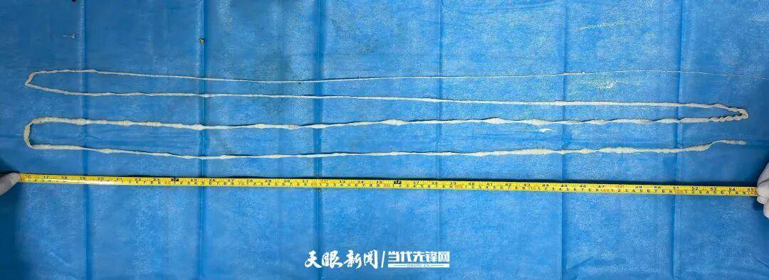 山口雷法 vs 千叶市原_最长4米!贵州一男子连续7个月排出“面条状异物”山口雷法 vs 千叶市原,医生:很可能和吃这种生食有关