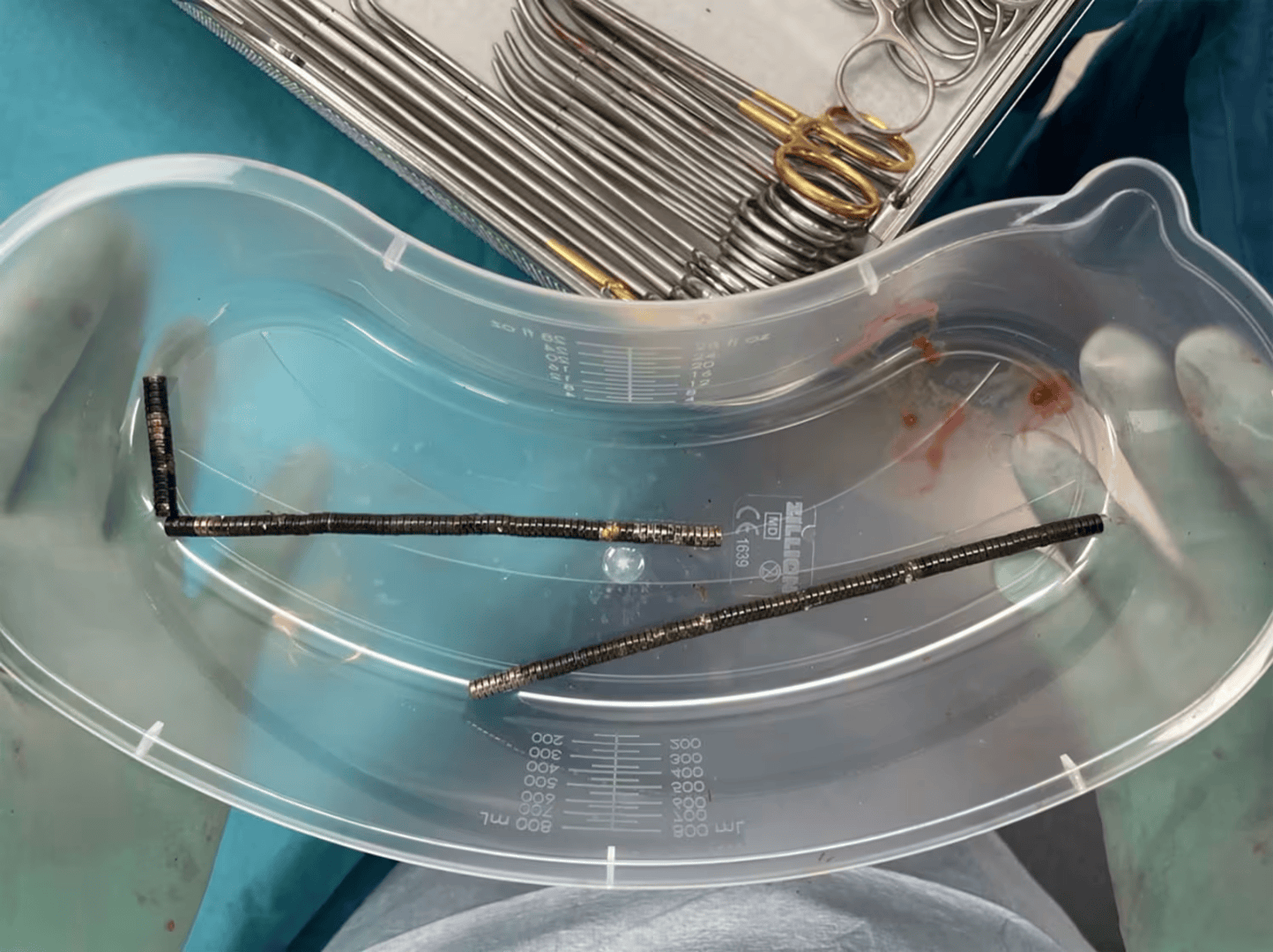 皇冠信用網出租代理
_腹痛4天后送医皇冠信用網出租代理
,新西兰男孩吞下约100颗磁铁致肠道坏死 医生切除部分肠组织